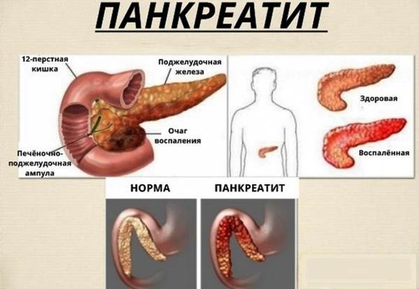 Панкреатит — воспаление поджелудочной железы Панкреатит — воспаление поджелудочной железы