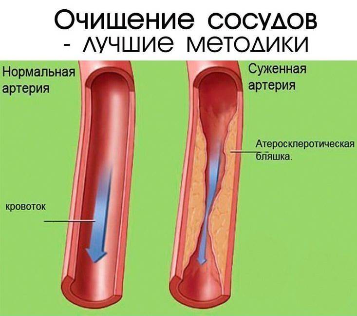 Очищение сосудов. Ольга Бутакова Очищение сосудов. Ольга Бутакова