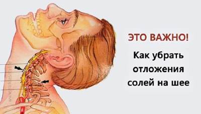 Убираем отложения солей на шее Убираем отложения солей на шее