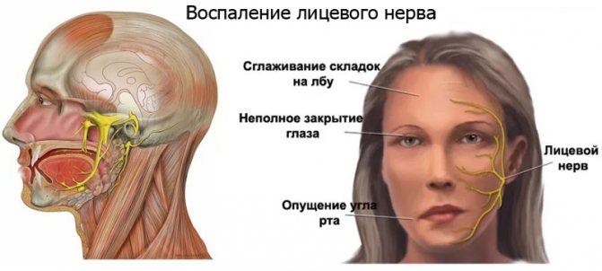 При воспалении лицевого нерва поможет соль При воспалении лицевого нерва поможет соль